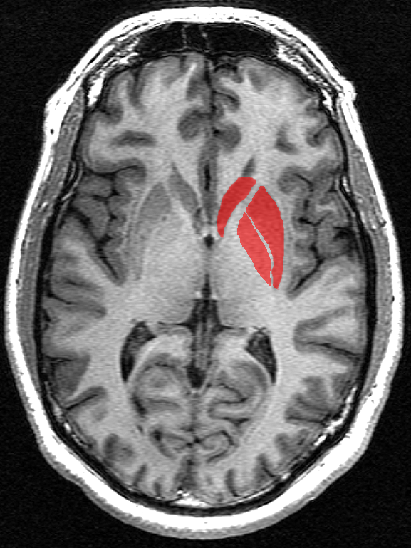 Basalganglierne (i rødt) er en række forbundne hjerneområder dybt inde i midten af hjernen. Disse hjerneregioner har længe været kendt for at lide mest skade under HS sygdomsforløbet.  