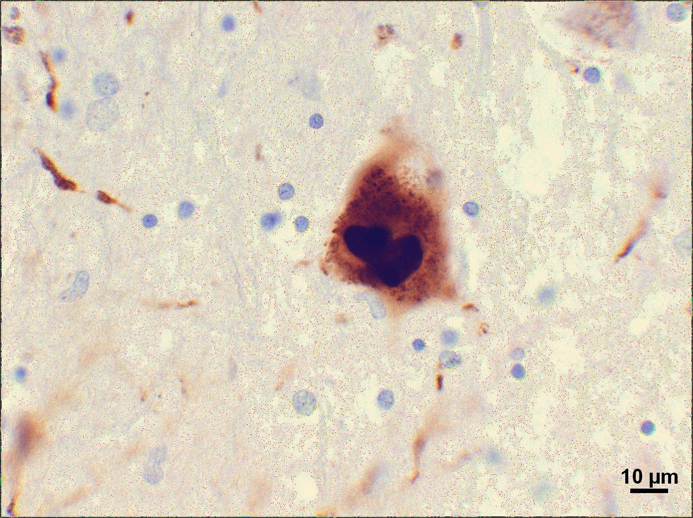 In the brains of Parkinson's disease patients, clumps of proteins called 'Lewy bodies' are found.  Recent work suggests that these clumps of junk can also be found in new, young, cells transplanted into the brains of PD patients.  