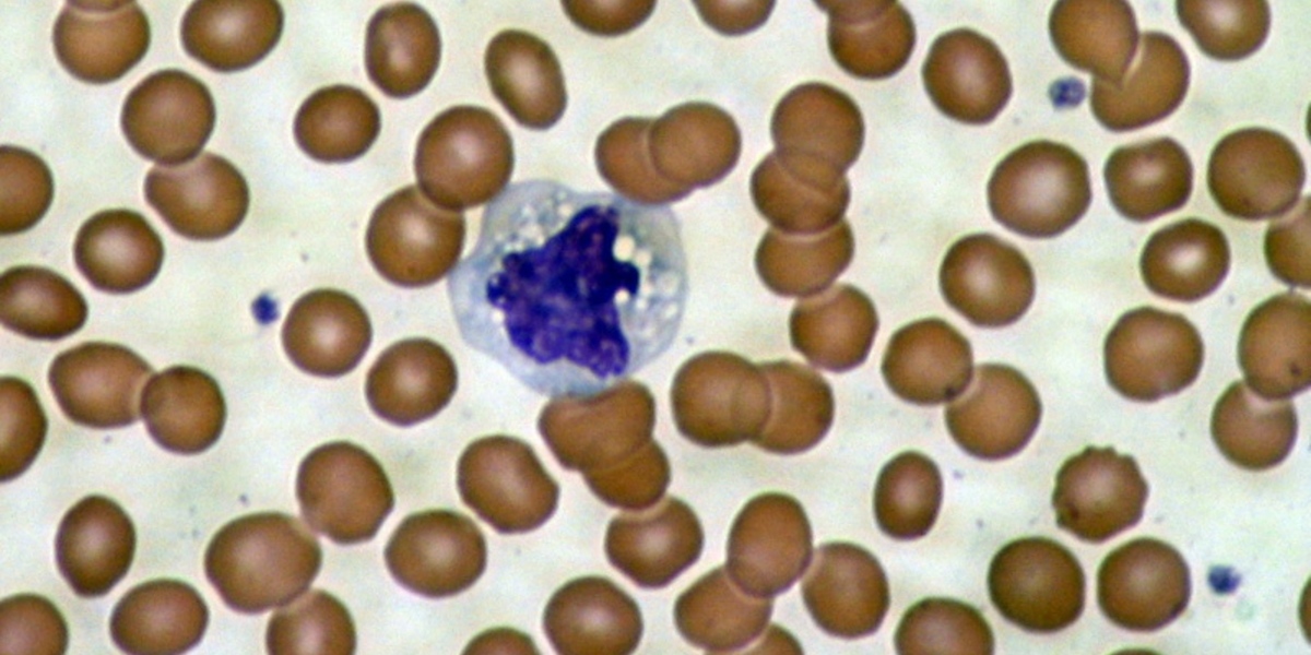 Spændende opdagelse i blodceller fra patienter med Huntingtons Sygdom