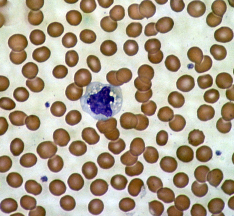 Et mikroskopi-billede af blodceller - røde blodceller omgiver en enkelt celle fra immunsystemet.  