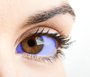 Som vist i denne kunstners udtryk,  farver methylenblåt det hvide i øjnene blåt. Det kunne give problemer med at afprøve lægemidlet på grund af placebo-effekt.  