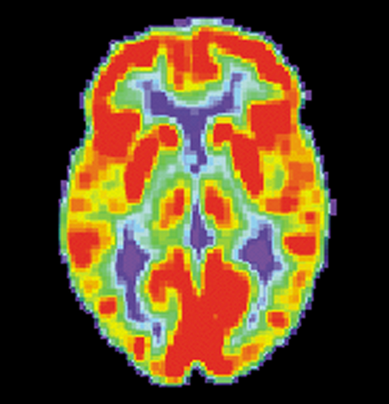 FDG-PET-skanninger gør os i stand til at se hvor meget sukker hver enkelt del af hjernen bruger. Dette er et skanningsbillede af en rask hjerne. De røde områder bruger mest energi.   
