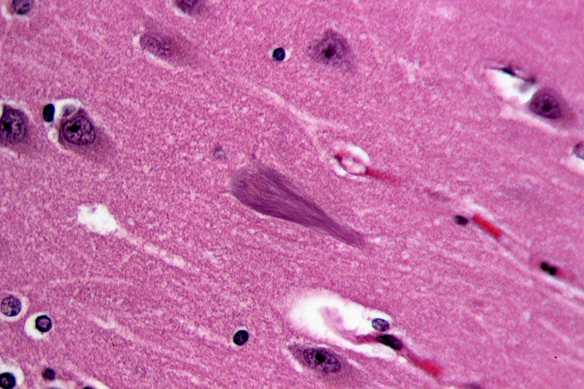 Linjerne i hjernecellen i midten af dette billede, der stammer fra en patient med Alzheimers Sygdom, er dannet af tau-proteiner, der er filtret ind i hinanden. Nye forsøg i Alzheimers Sygdom tyder på, at filtrede tau-proteiner kan hoppe fra én hjernecelle til en anden.   